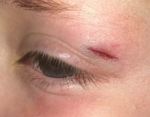 Eyelid Laceration Best Wound Practice