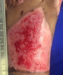 Eleven days after scald burn to left foot