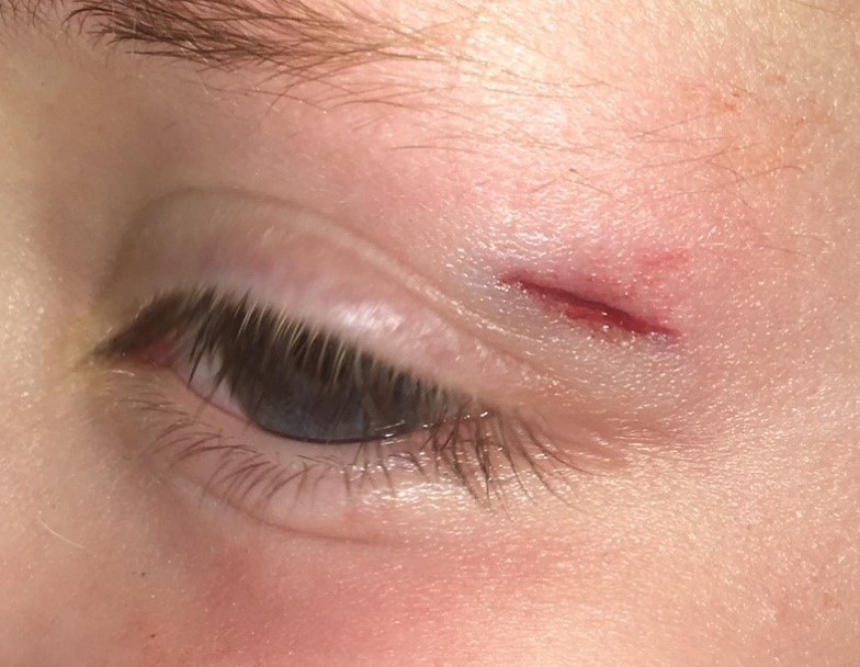 5 year old girl, fell down the stairs and sustained an 8x2mm eyelid laceration. Closed with SteriStrips and then shown 8 months later.