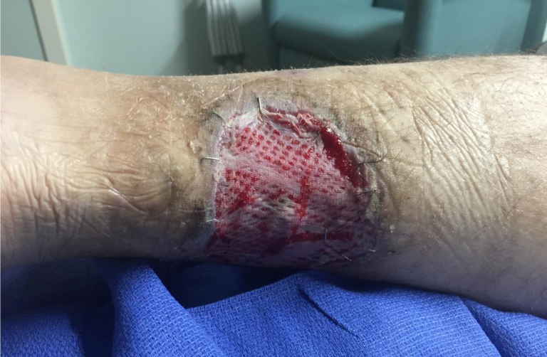 Pyoderma Gangrenosum - Best Wound Practice