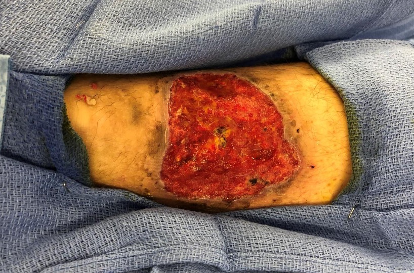 29-year-old man with a recurrent left lower extremity wound, diagnosed with pyoderma gangrenosum. Status post 1-week of treatment with dehydrated human amnion/chorion membrane (dHACM). The patient went on to receive a split-thickness skin graft.