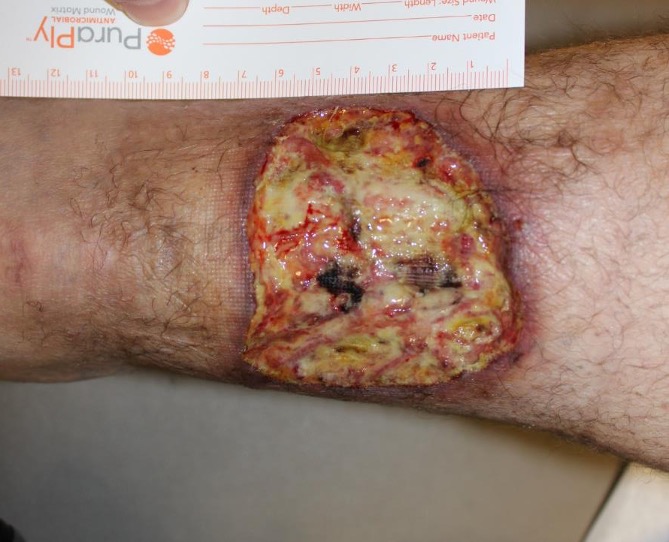 29 yo man with a 3-year history of a recurrent left posterior calf wound measuring 9x7cm.