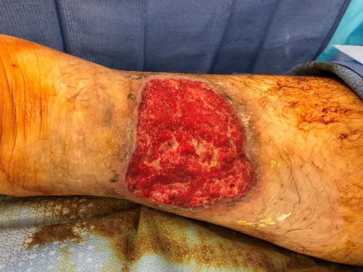 A 29-year-old man with a recurrent left posterior  calf wound immediately post-debridement. Tissue biopsy of the wound revealed mixed pyoderma gangrenosum and vasculitis.
