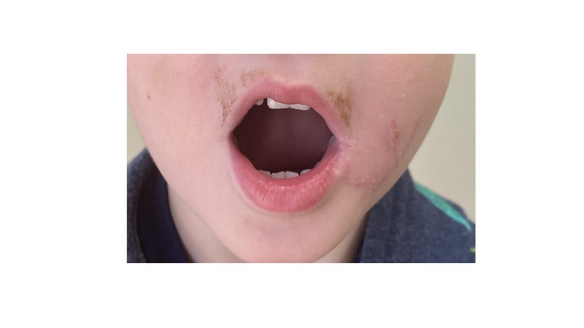Stellate lip and cheek laceration best wound practice