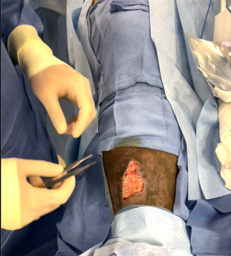 Intra-operative application of dHACM to a lower leg wound of a 29 year old man with pyoderma gangrenosum.