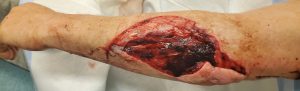 Forearm wound at presentation