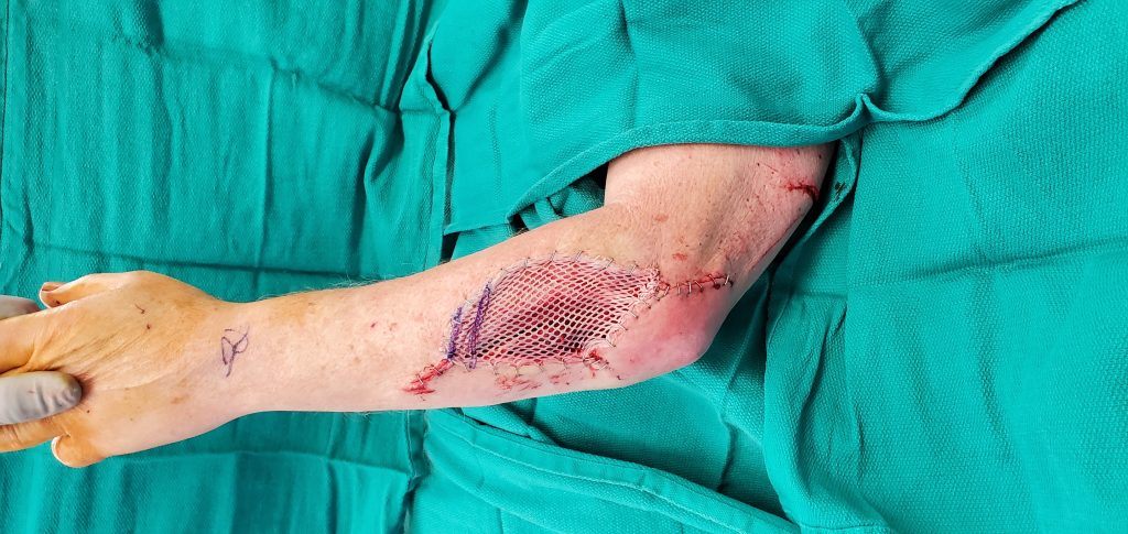Split-thickness skin graft to the forearm avulsion wound