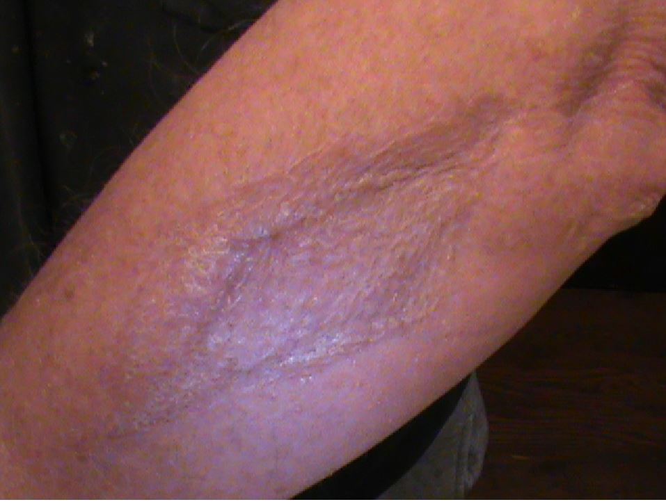 Forearm wound at 1-year follow up