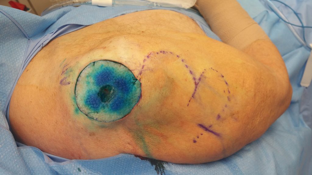 Pre-operative photo (compilation) of a large apex shoulder surgical defect