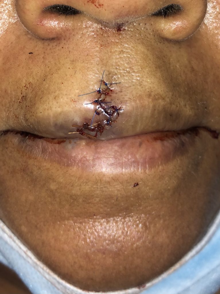 This image illustrates the wound after placing the sutures. The patient was scheduled for follow up in 1 week for suture removal.
