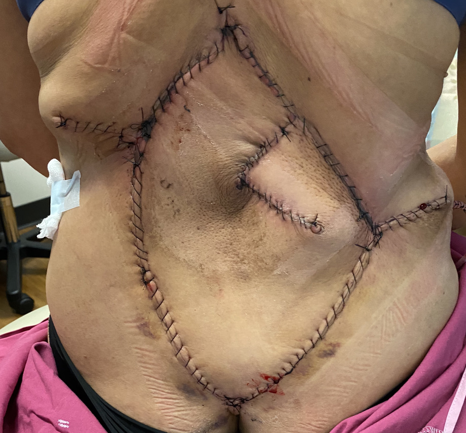 Lumbar Reconstruction at Two Weeks 
