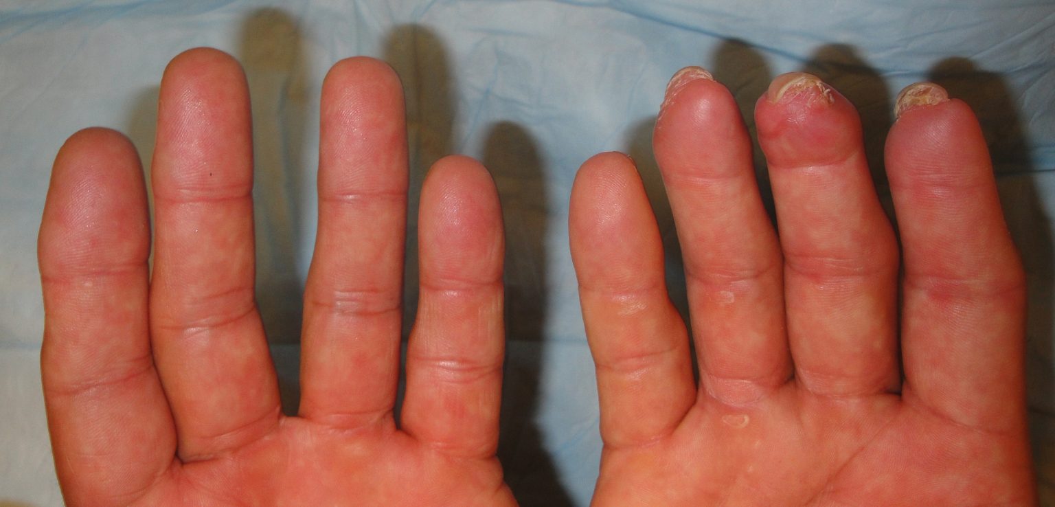 Multiple Fingertip Amputations Best Wound Practice