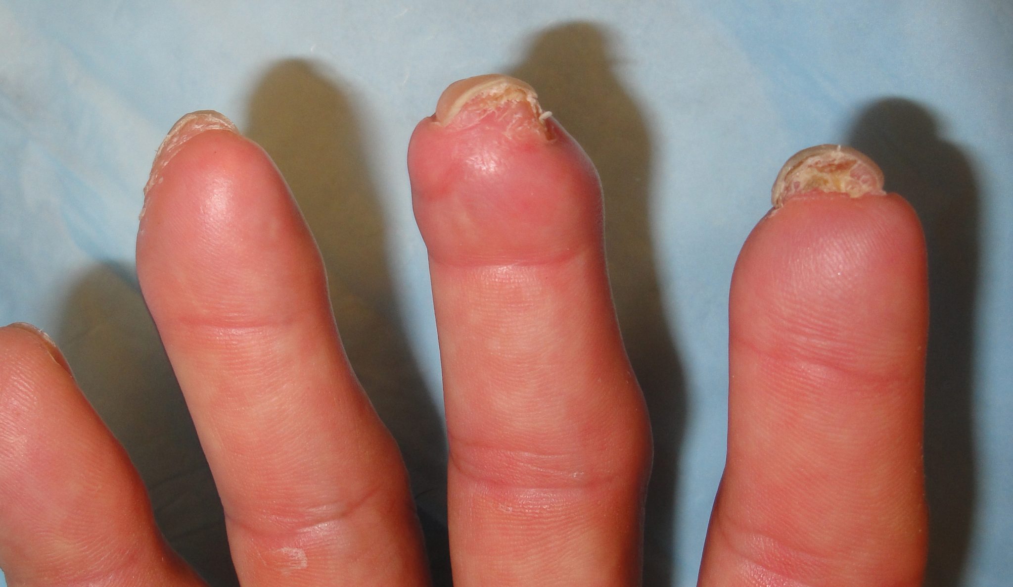 Multiple Fingertip Amputations Best Wound Practice