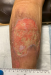 Piyoderma Pyoderma Gangrenosum - Best Wound Practice