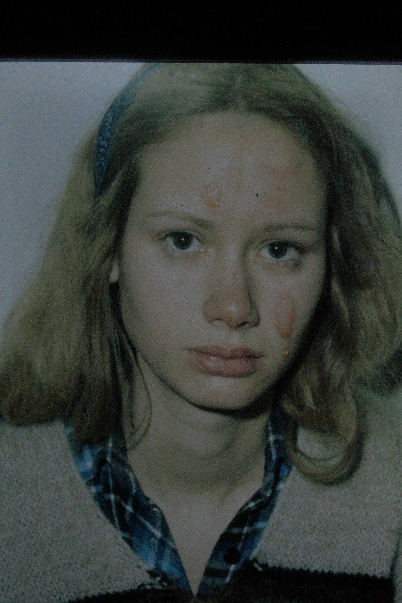 Facial Burn, Superficial (1st degree) Healed with Topical Treatment