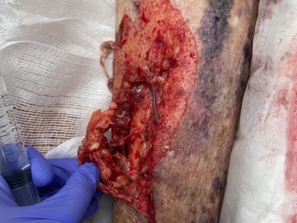 Soft tissue avulsion injury to medial left lower leg