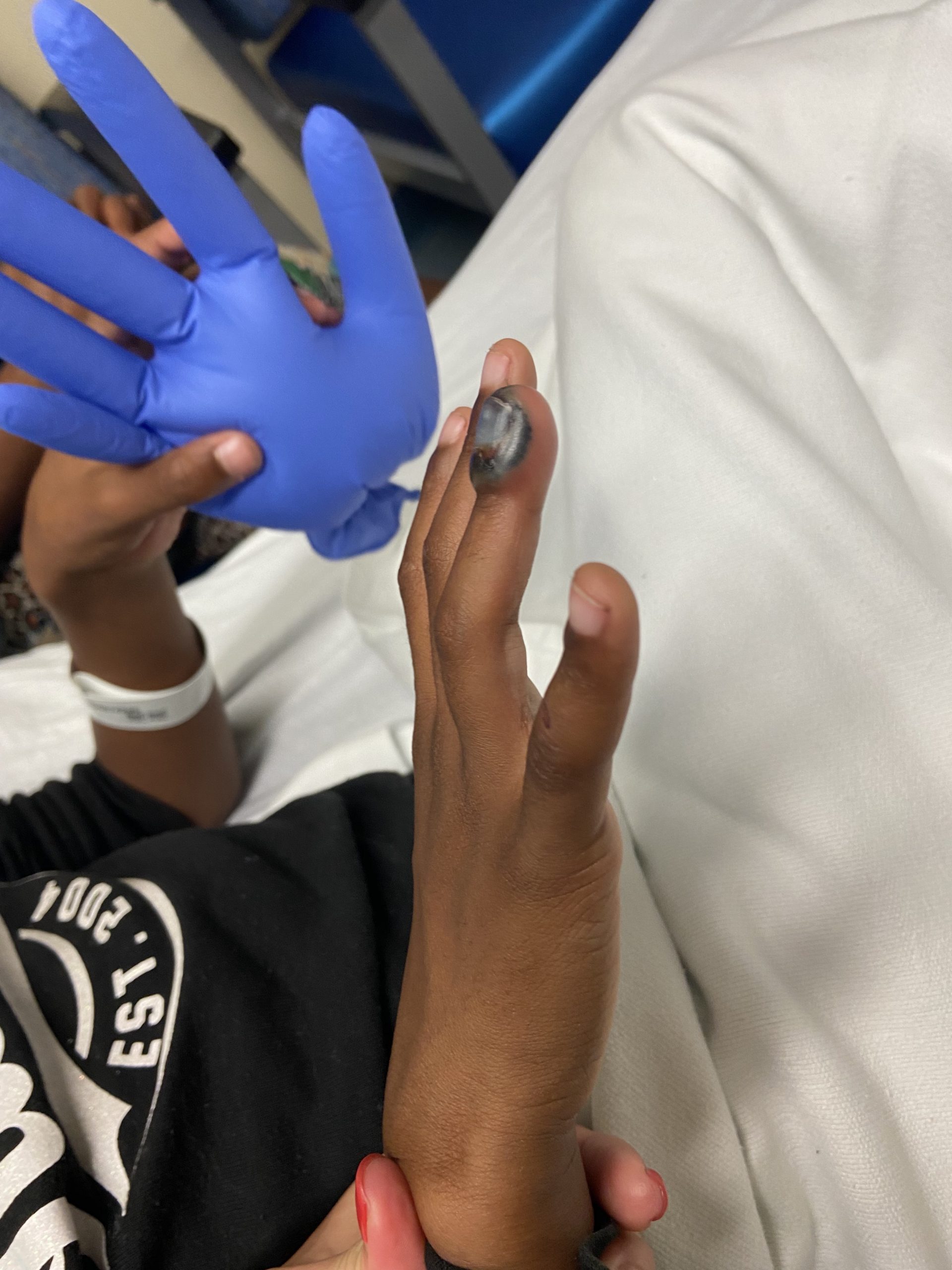 Pediatric Subungual Hematoma and Nail Bed Laceration Best Wound Practice