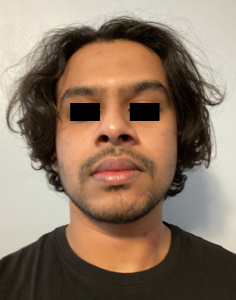 laceration wound of chin icd 10