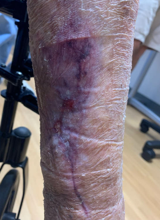4-month post-injury of medial wound