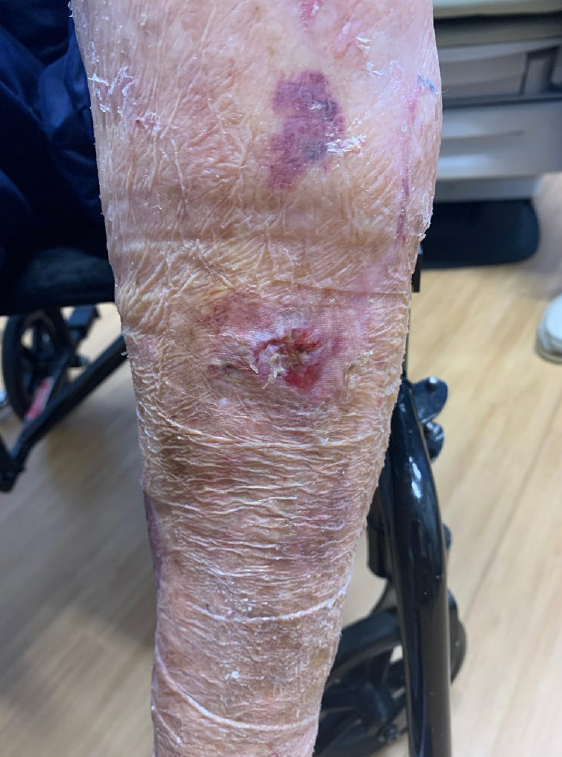 4-month post-injury of lateral wound