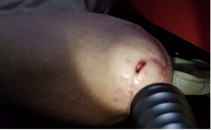 Chronic elbow wound initially