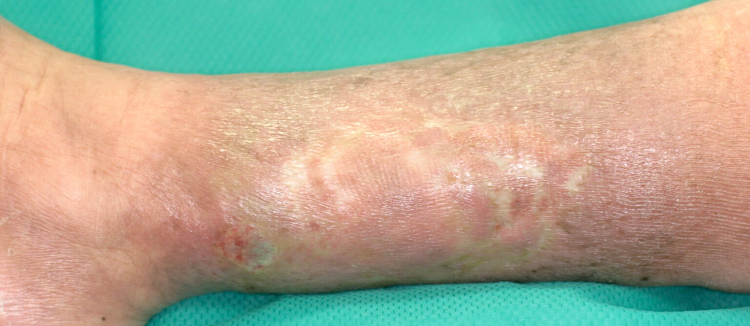 Infected Venous Leg Ulcer Best Wound Practice