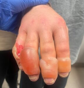 Frostbite injury to the bilateral hands approximately 24 hours following cold exposure. 