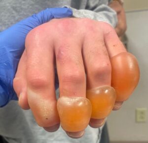 Frostbite injury to the bilateral hands approximately 24 hours following cold exposure. 