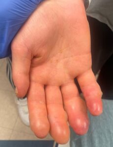 Frostbite injury to the bilateral hands approximately 24 hours following cold exposure. 