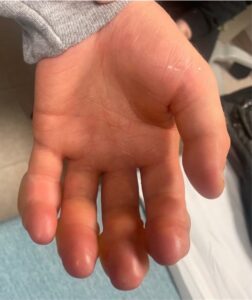 Frostbite injury to the bilateral hands approximately 24 hours following cold exposure. 