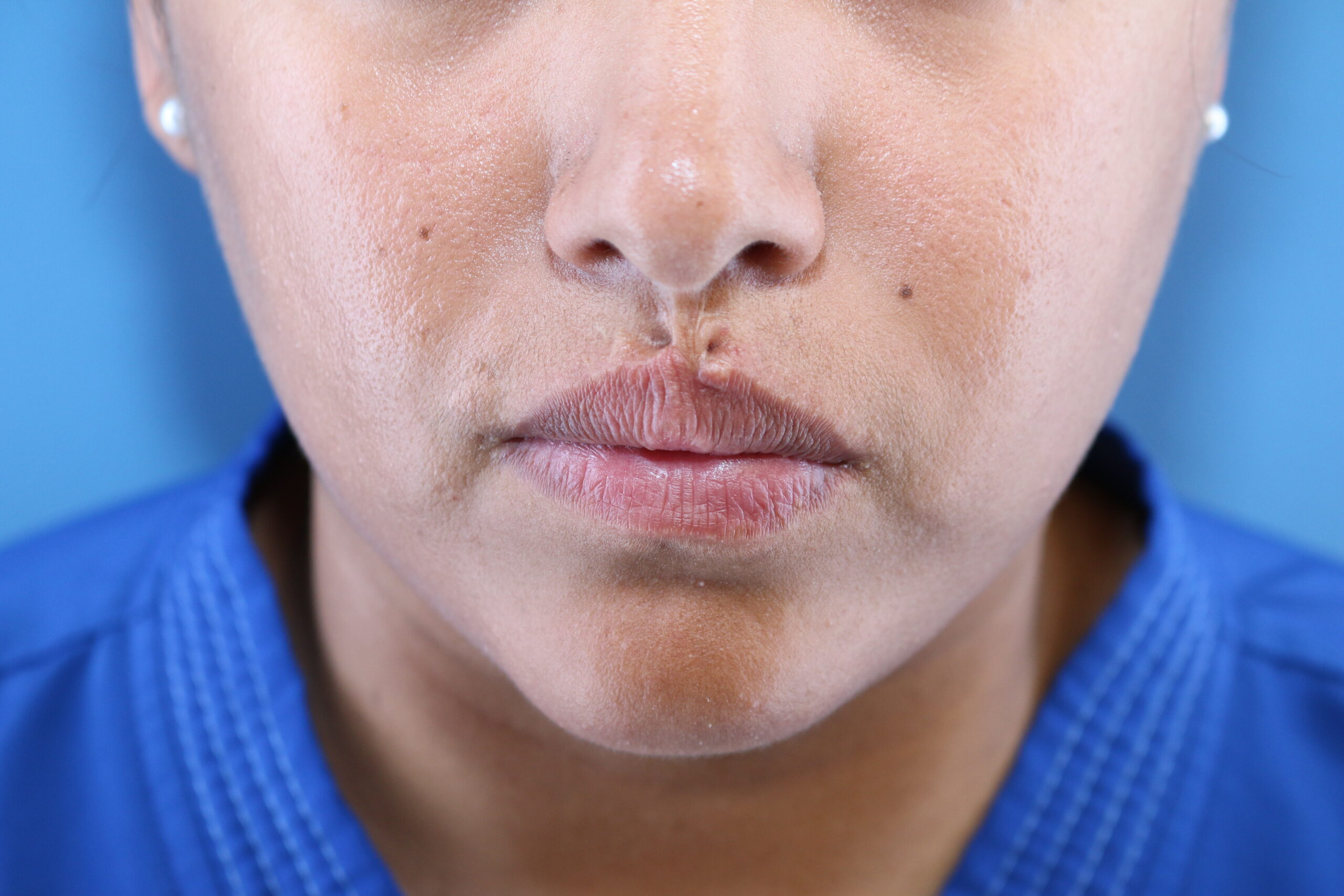 Bridged scar of the philtrum