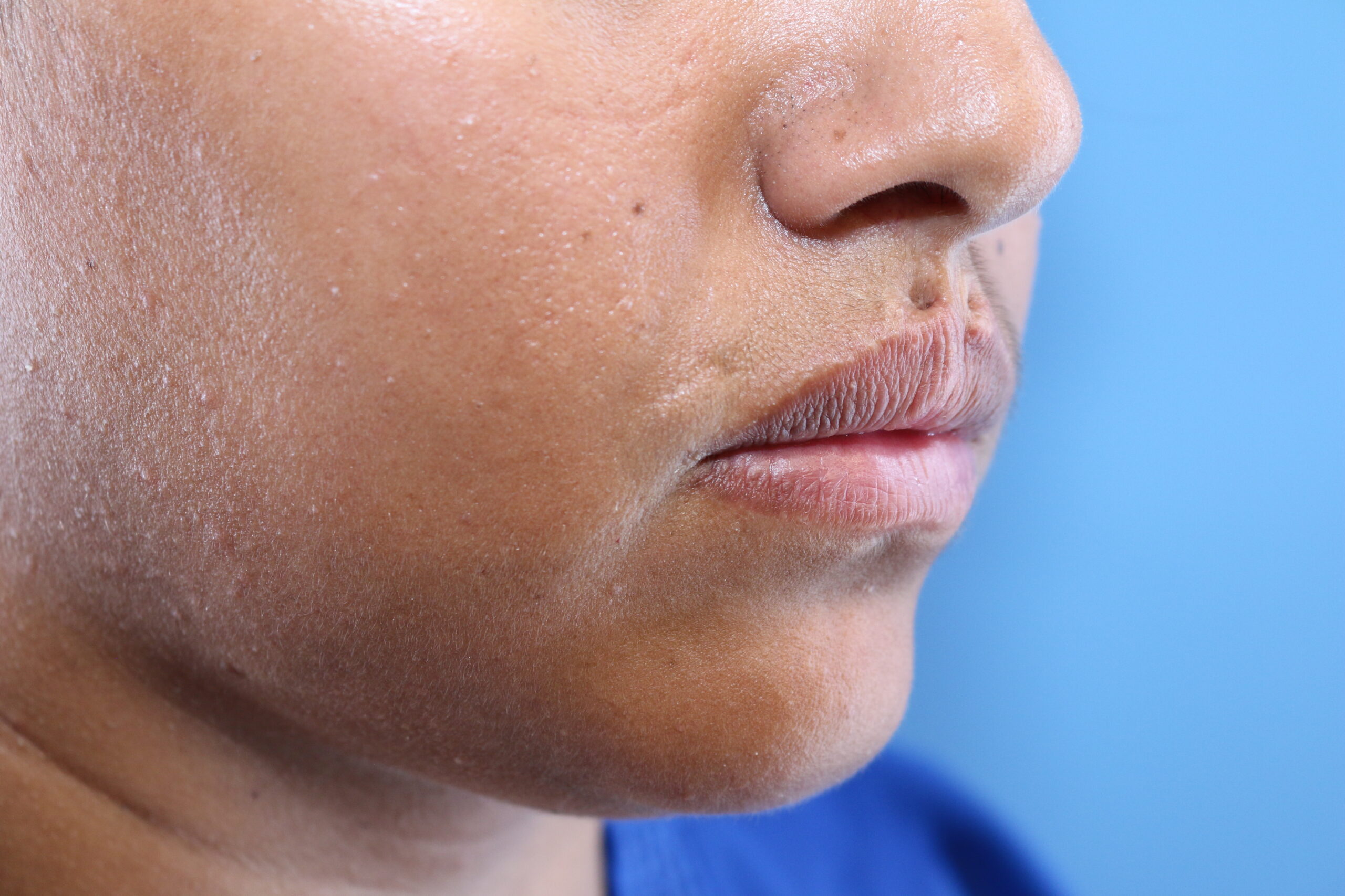 bridged scar philtrum