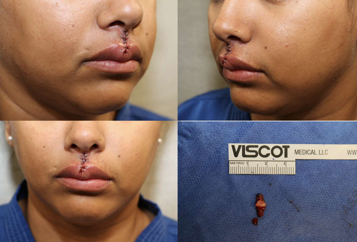 philtrum bridge scar excision reconstruction