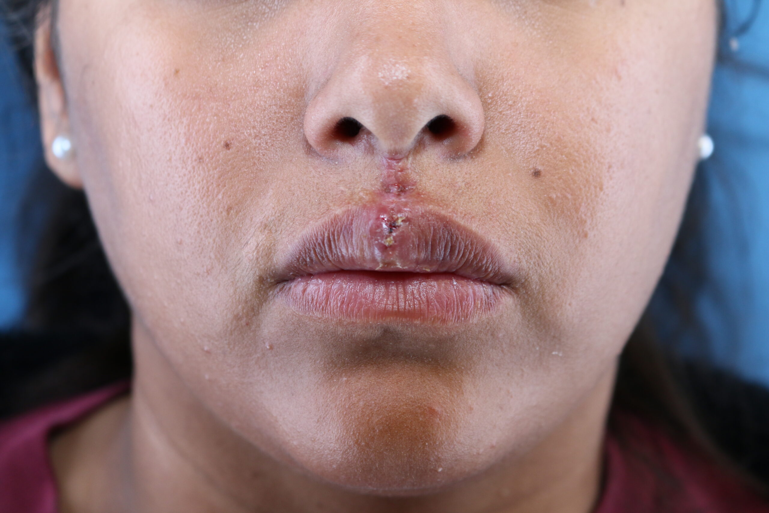 1 week post philtrum reconstruction