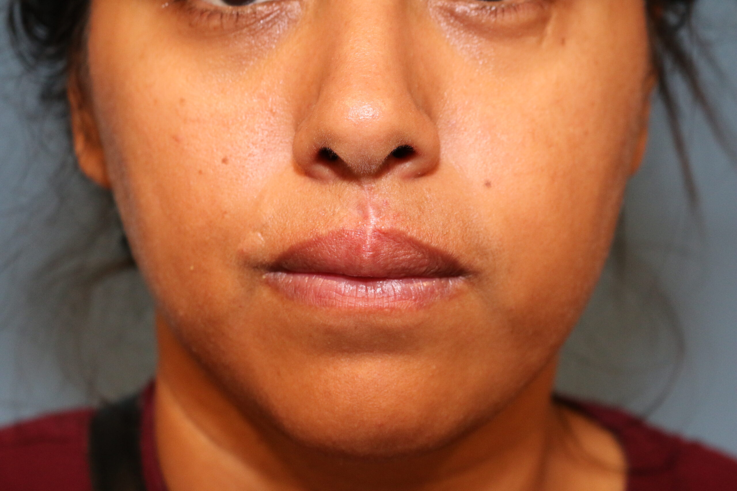 Post-Operative review at 10 weeks anterior view at rest.