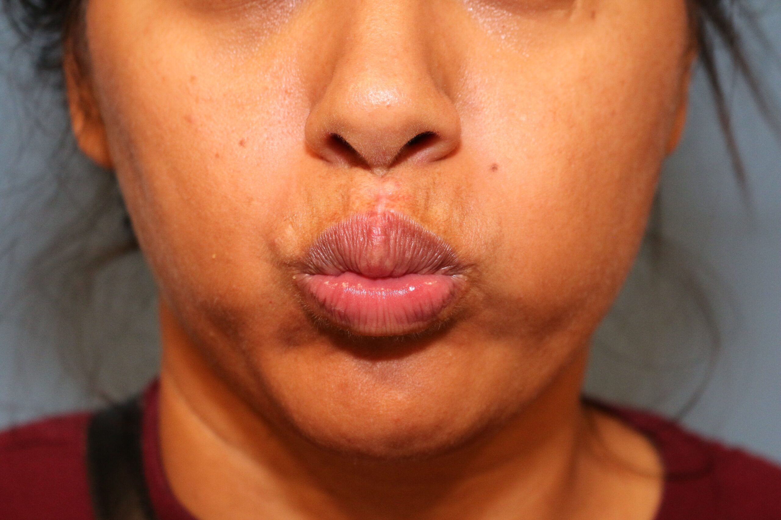Post-Operative review at 10 weeks anterior view at rest.